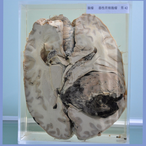 脑瘤